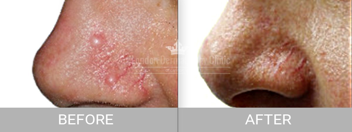 Mole Before After Removal