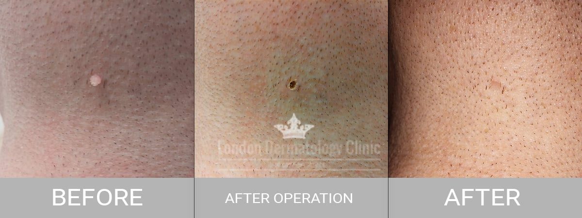 Before and After Skin Tag Removal