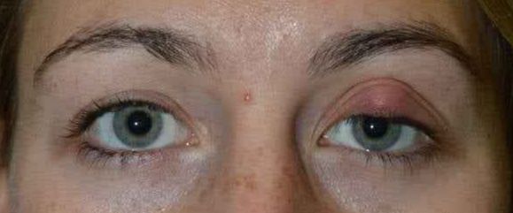 Removal of on sale a chalazion