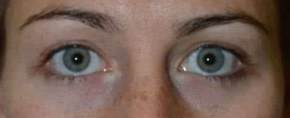 After Chalazion Removal