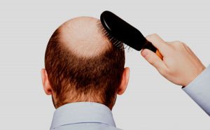 Hair Loss Dermatology London