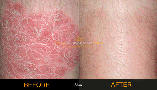 before and after laser treatment for psoriasis