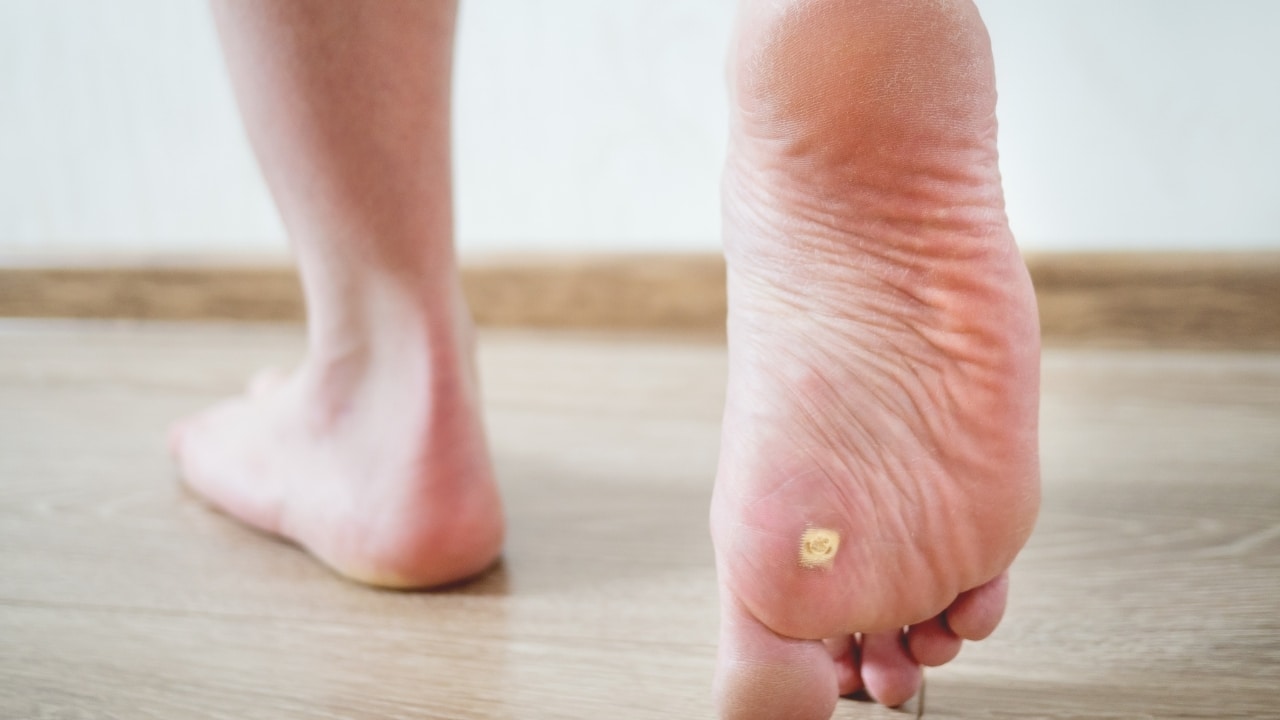 Verrucas Removal in London London Dermatology Clinic