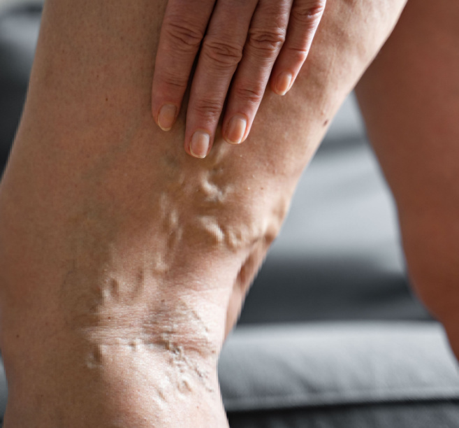 varicose-vein-removal-cost