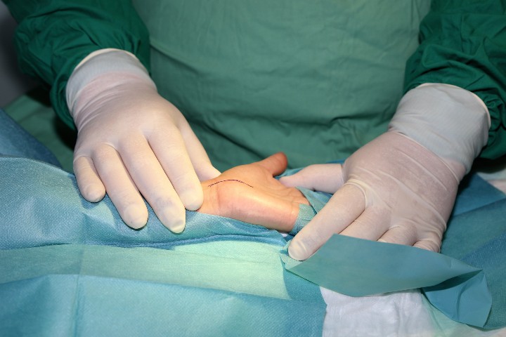 carpal-tunnel-release-surgery2