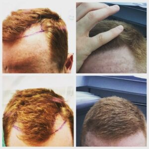 Hair Transplant-1