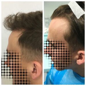 Hair Transplant-2