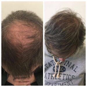 Hair Transplant-4
