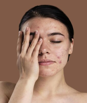 Pregnancy Acne Causes Treatments