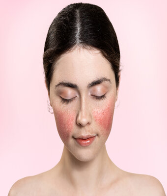 Understanding Rosacea: More Than Just Redness