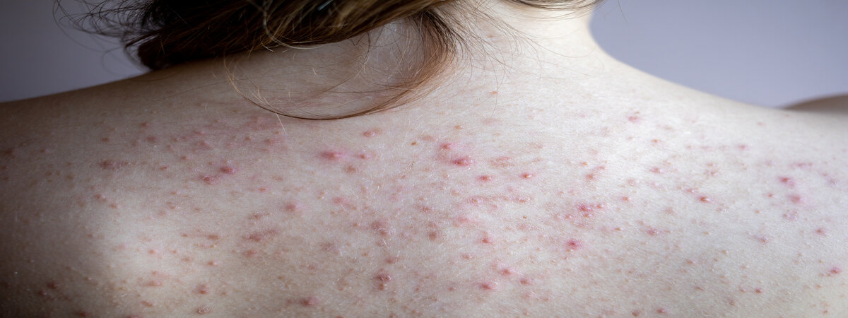 Seborrheic Dermatitis Raleigh Nc