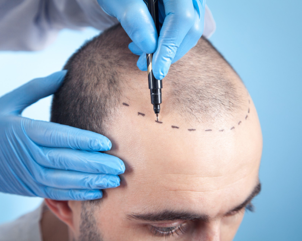 hairtransplant (1) hairtransplant (1)
